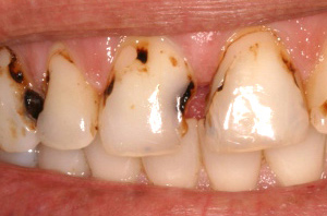 расипување на забите